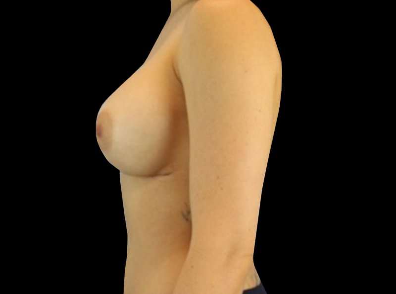 Revision Breast Surgery Before & After Patient #1184