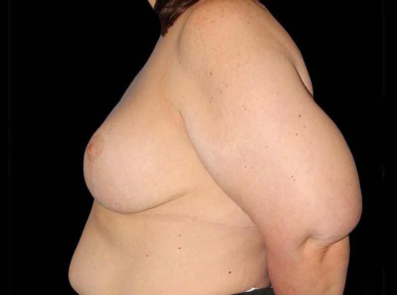 Revision Breast Surgery Before & After Patient #1195