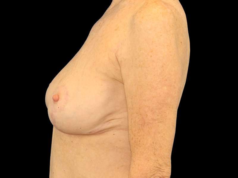 Breast Reduction Before & After Patient #1239