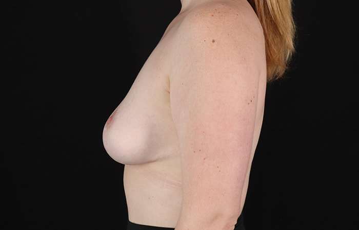 Breast Reduction Before & After Patient #1250