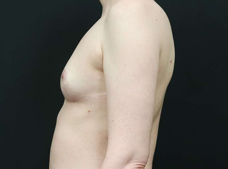 Breast Reduction Before & After Patient #1261