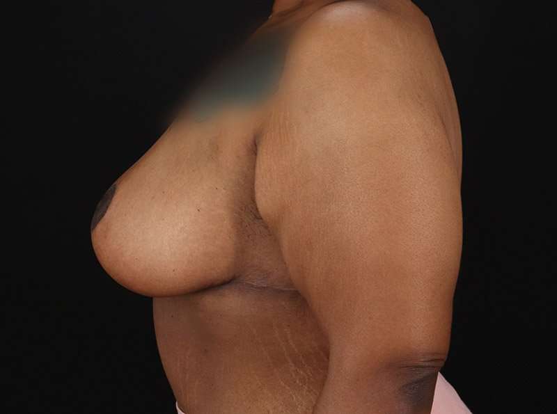 Breast Reduction Before & After Patient #1272