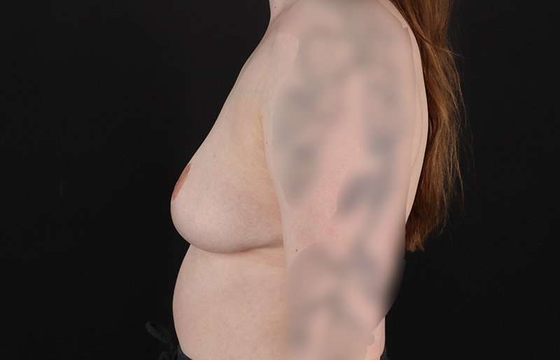 Breast Reduction Before & After Patient #1305