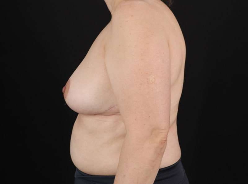 Breast Reduction Before & After Patient #1321