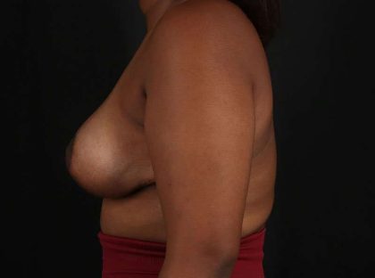 Breast Lift Before & After Patient #1343