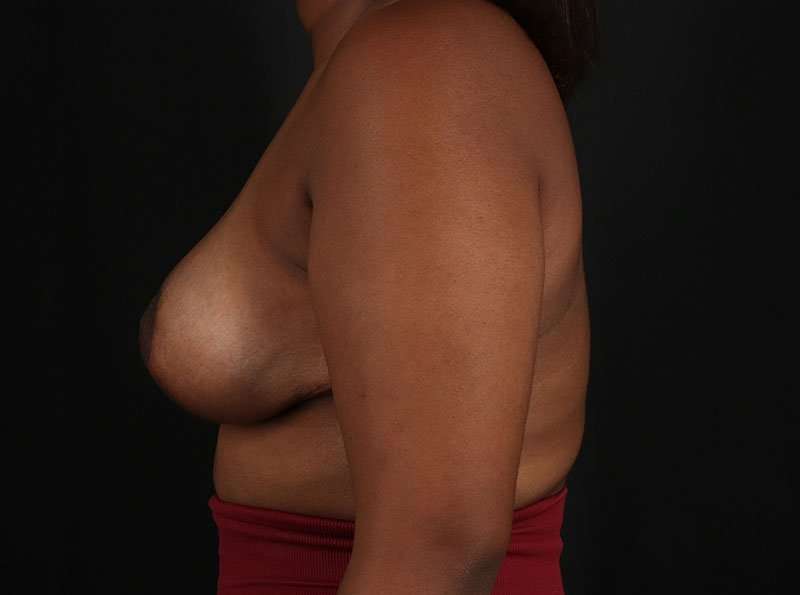 Breast Lift Before & After Patient #1343