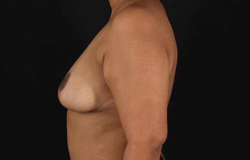 Breast Reduction Before & After Patient #1354