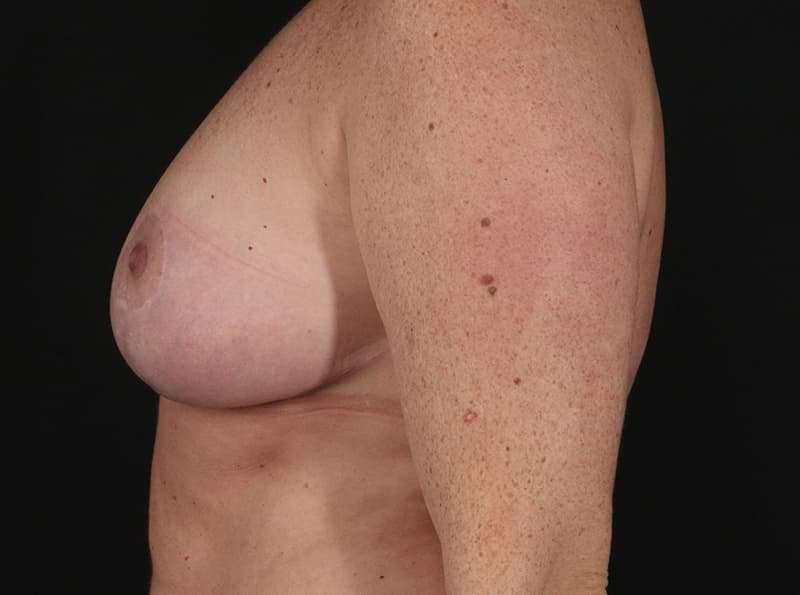Breast Reduction Before & After Patient #1365