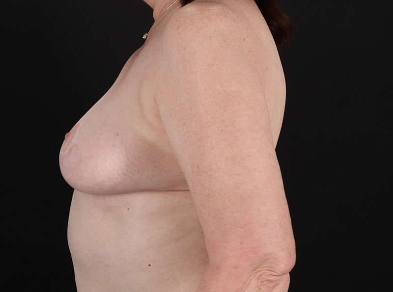 Breast Reduction Before & After Patient #1376