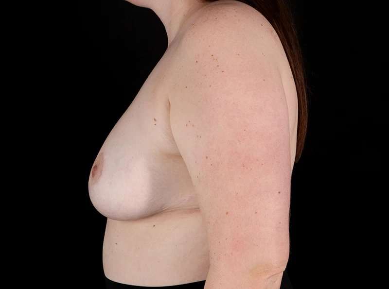 Breast Reduction Before & After Patient #1409