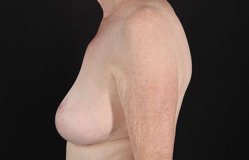 Breast Reduction Before & After Patient #1442