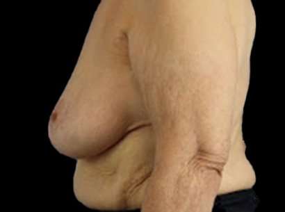 Breast Reduction Before & After Patient #1464