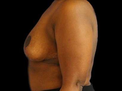 Breast Reduction Before & After Patient #1475