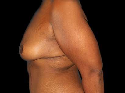 Breast Reduction Before & After Patient #1486