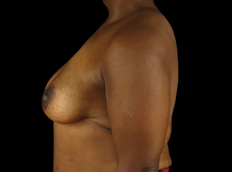 Breast Augmentation - Implant Before & After Patient #954