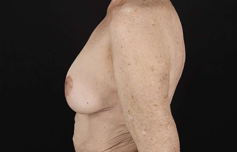 Augmentation/Lift Before & After Patient #1544