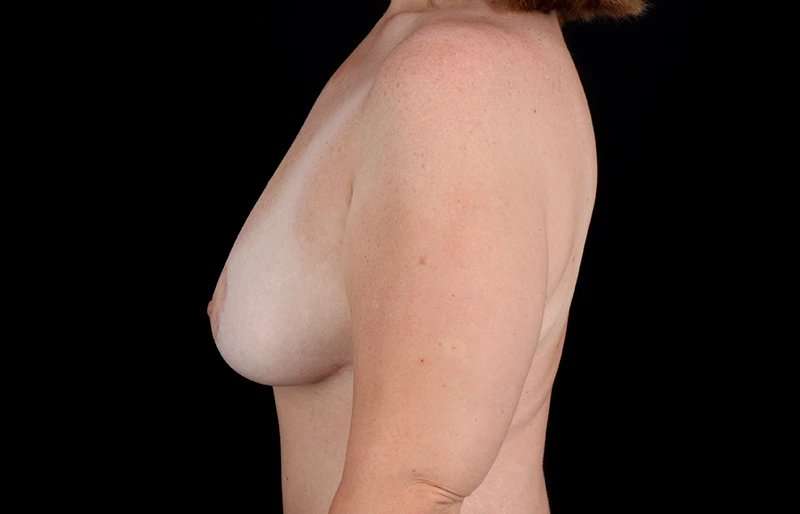 Augmentation/Lift Before & After Patient #1568