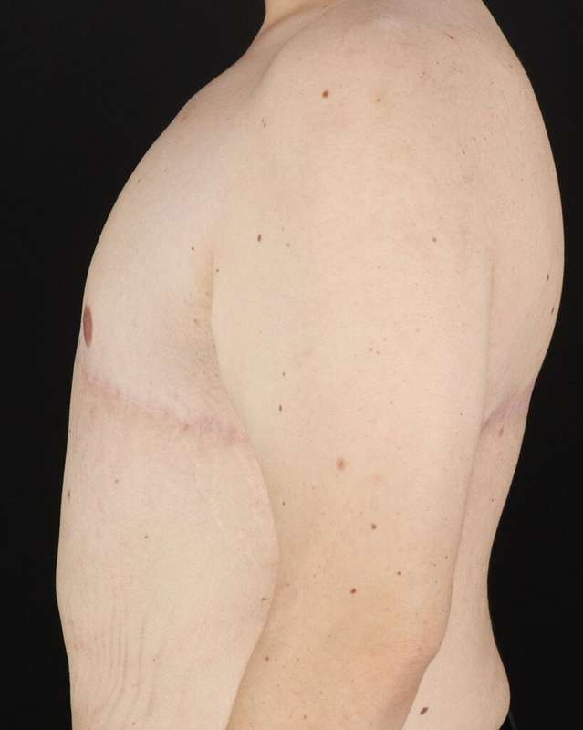 Gynecomastia Before & After Patient #1603