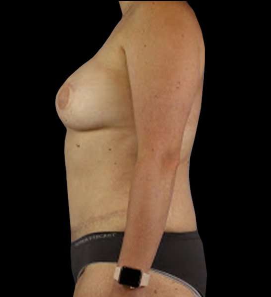 DIEP Flap Reconstruction Before & After Patient #1645