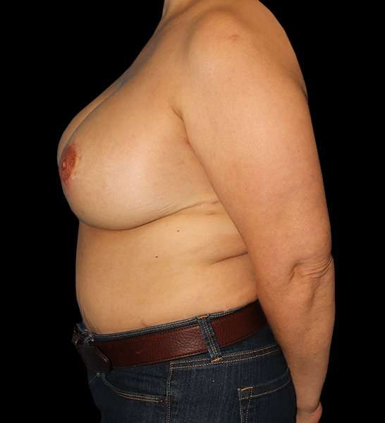 DIEP Flap Reconstruction Before & After Patient #1663