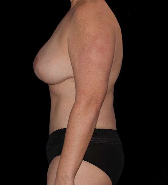 DIEP Flap Reconstruction Before & After Patient #1674