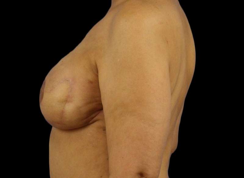 DIEP Flap Reconstruction Before & After Patient #1707
