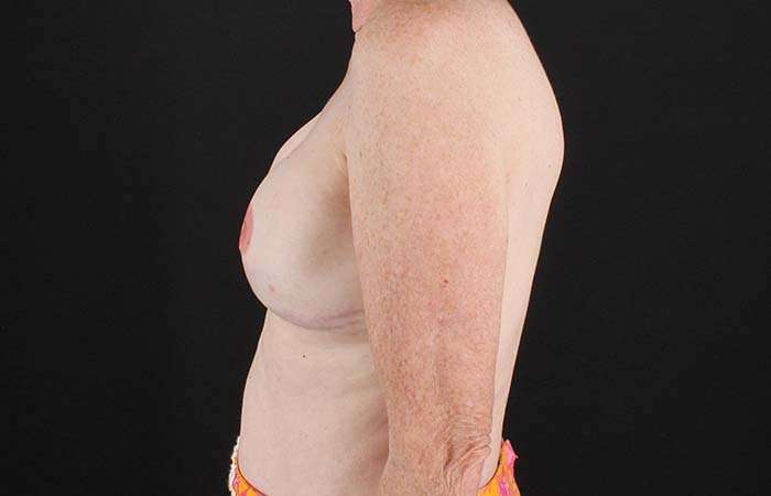 Implant Based Breast Reconstruction Before & After Patient #1718