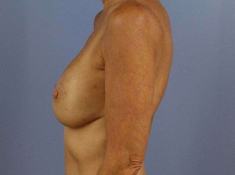 Implant Based Breast Reconstruction Before & After Patient #1729