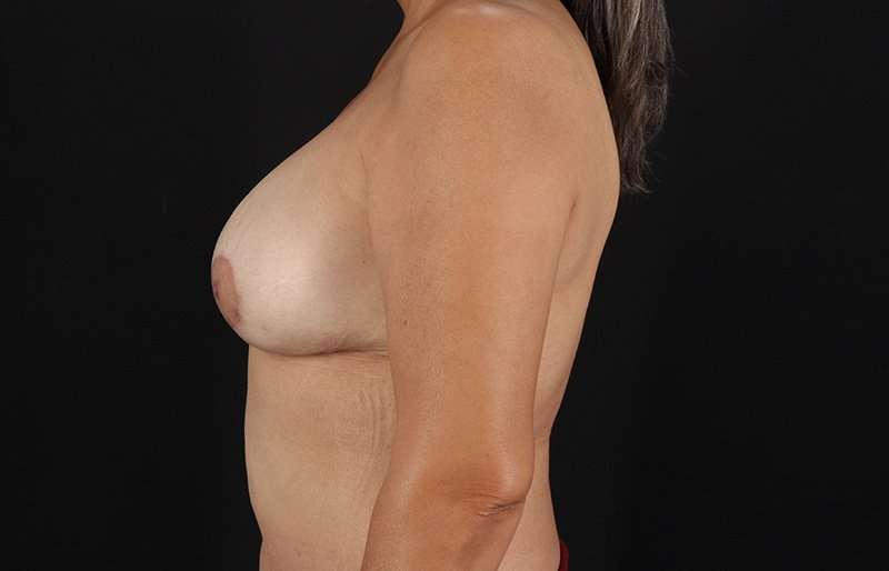 Implant Based Breast Reconstruction Before & After Patient #1751