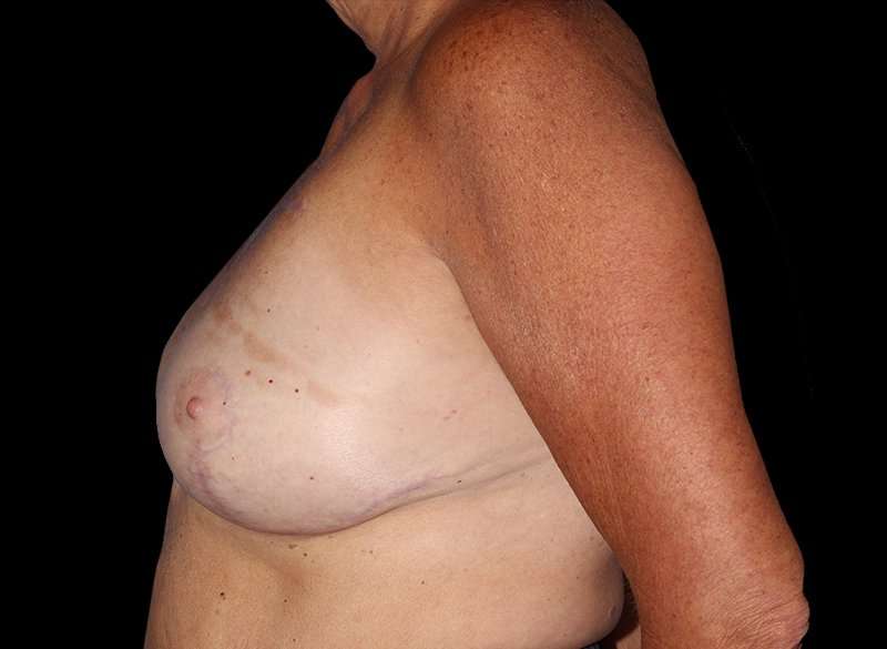 Oncoplastic Reconstruction Before & After Patient #1762
