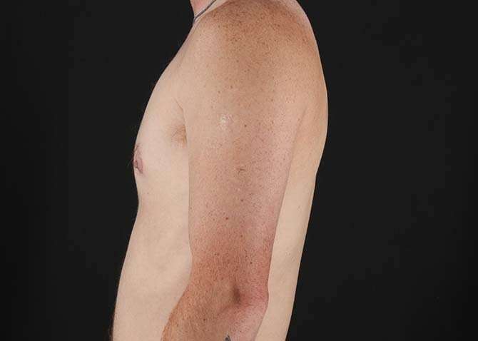 FTM Chest Contouring Before & After Patient #1864