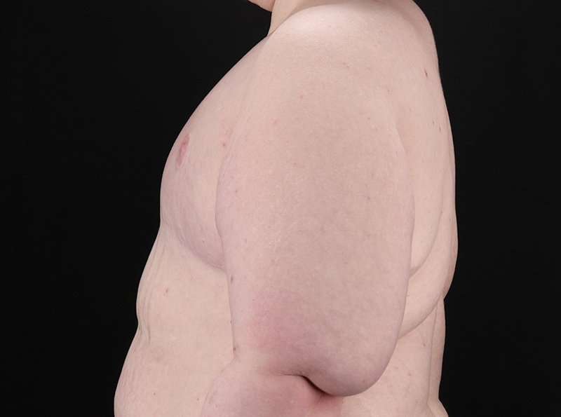 FTM Chest Contouring Before & After Patient #1875
