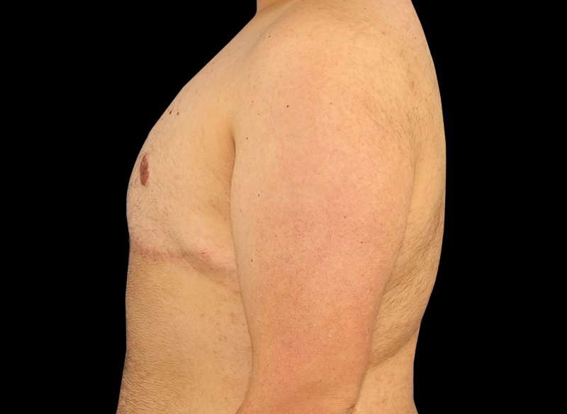 FTM Chest Contouring Before & After Patient #1886