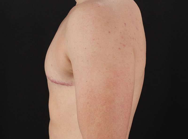 FTM Chest Contouring Before & After Patient #1918