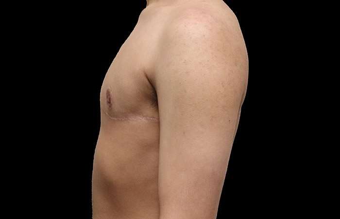 FTM Chest Contouring Before & After Patient #1929