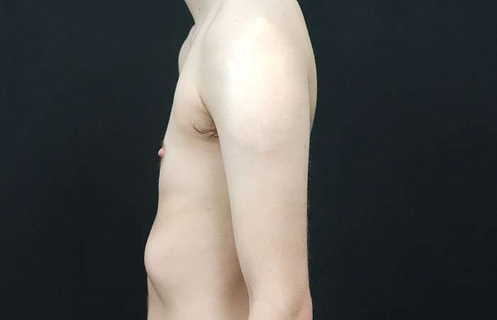 FTM Chest Contouring Before & After Patient #1940