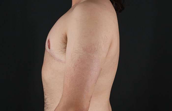 FTM Chest Contouring Before & After Patient #1951