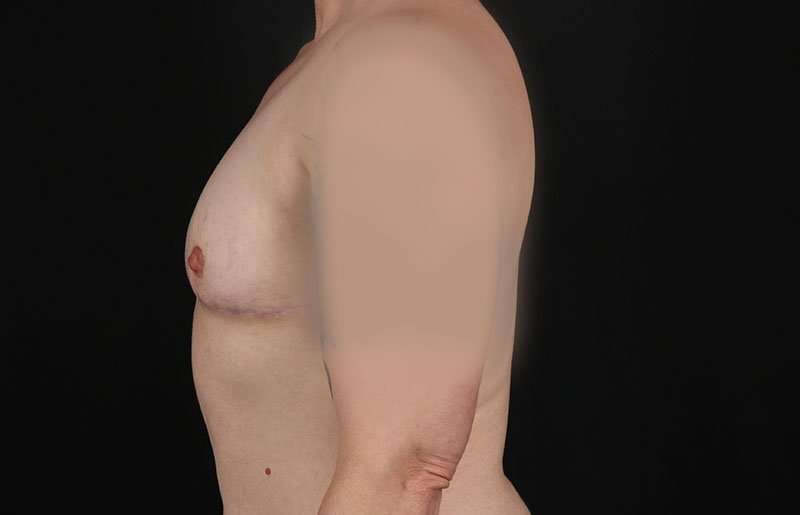 FTM Chest Contouring Before & After Patient #1973