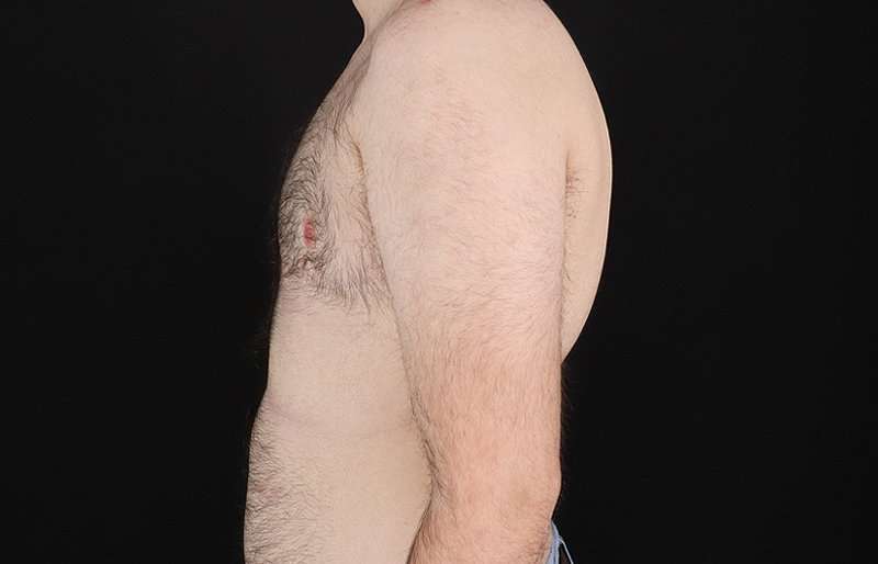 FTM Chest Contouring Before & After Patient #1984