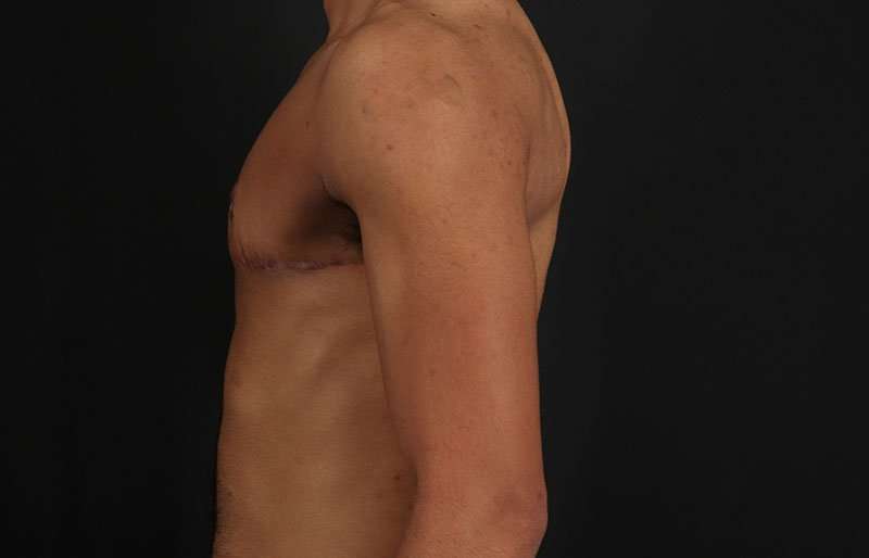 FTM Chest Contouring Before & After Patient #1995