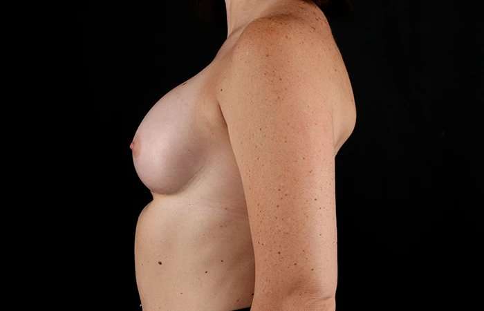 Breast Augmentation - Implant Before & After Patient #1012