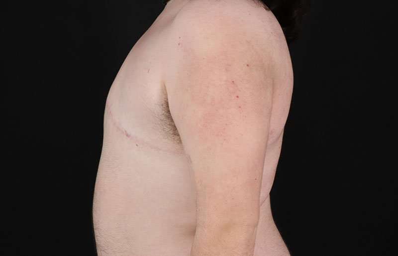 FTM Chest Contouring Before & After Patient #2006