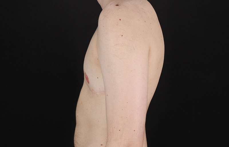 FTM Chest Contouring Before & After Patient #2017