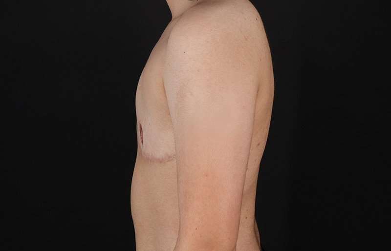 FTM Chest Contouring Before & After Patient #2028