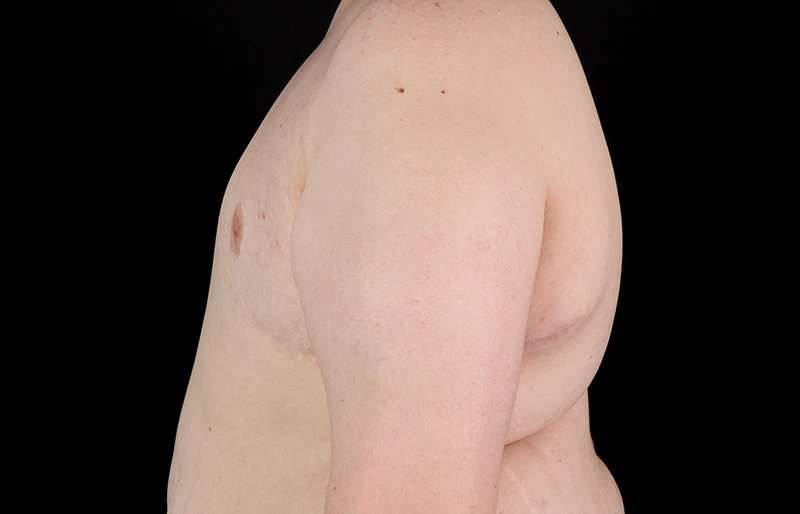 FTM Chest Contouring Before & After Patient #2039
