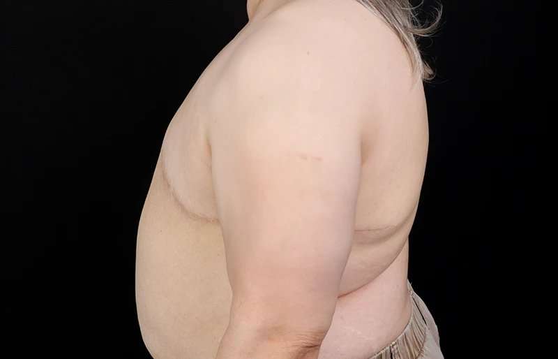 FTM Chest Contouring Before & After Patient #2050