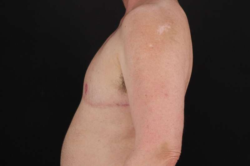 FTM Chest Contouring Before & After Patient #2061