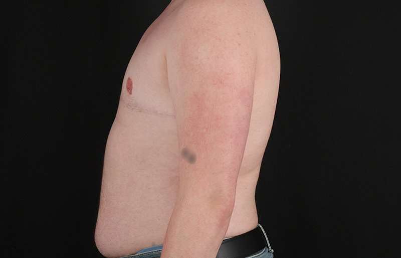 FTM Chest Contouring Before & After Patient #2072