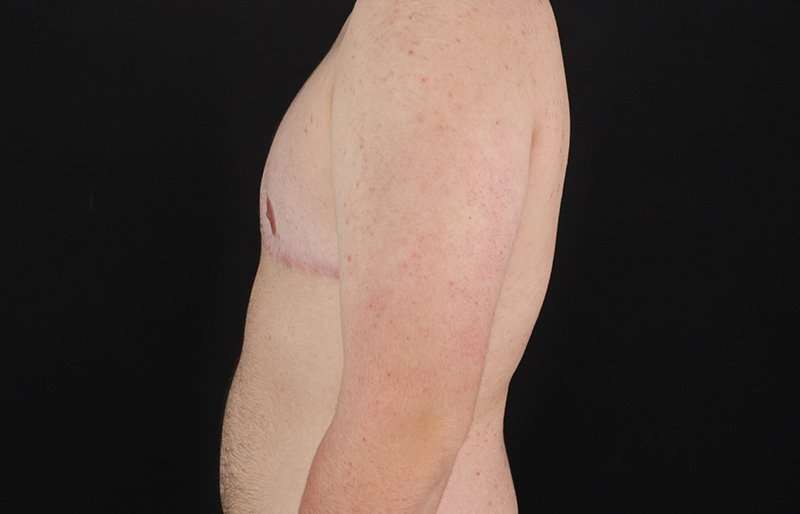 FTM Chest Contouring Before & After Patient #2083