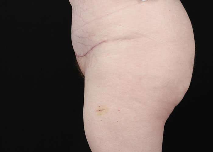 Monsplasty Before & After Patient #2106